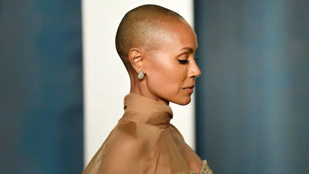 Jada Pinkett Smith Alopecia